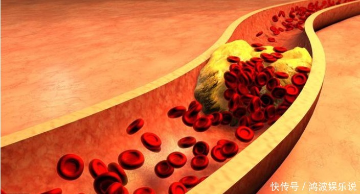 身上这4处疼痛,可能是血管堵了,做好3件事,保持血管畅通