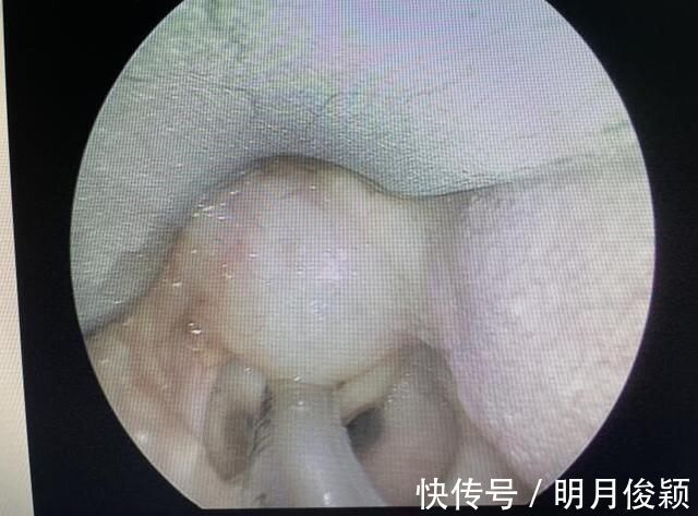 气管插管|真·如鲠在喉!济一2个月小孩嗓子里长了巨大肿瘤