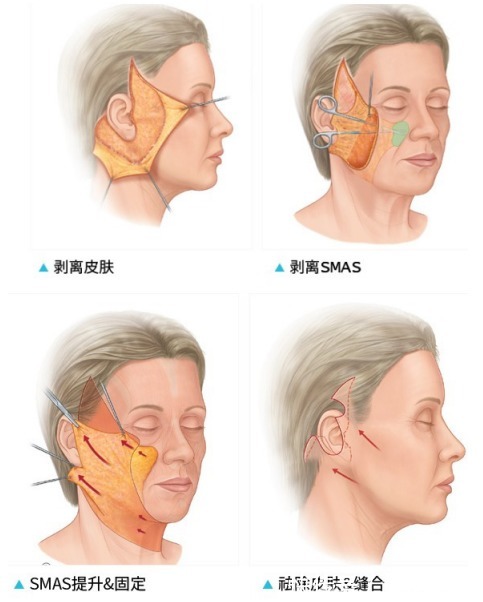 smas 现在拉皮手术的名字那么多,大拉皮、小拉皮、到底应该怎么选?