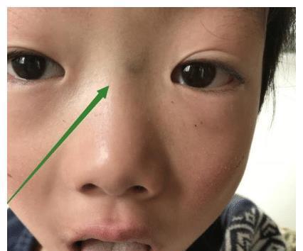 积食|孩子若有积食,脸上3个“异常”瞒不住,一个没有,恭喜孩子脾胃