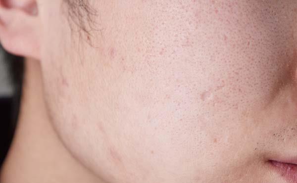 皮肤状态|每日跑步5千米,30天之后,身体会发生怎样的变化?