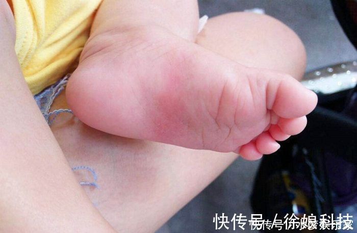 医生|4岁男孩脚部轻微“畸形”,只因妈妈过于节俭,医生:胡闹!