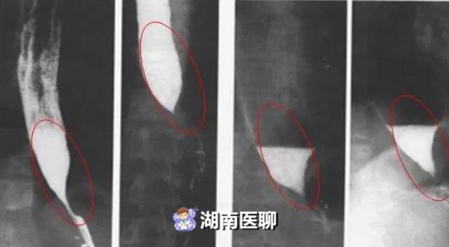 贺平波|大妈吞咽困难二年多,以为是更年期六次胃镜后查出“真正凶手”