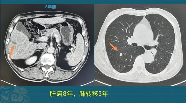 生存期|多数人得了癌症后，为何有人几个月就离世有人却非常长寿