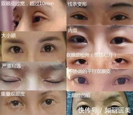 手术 什么样的双眼皮手术意味着失败了?术后多久才能进行二次修复?看完这篇,你就知道啦~