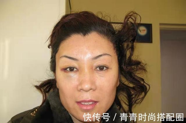 拉皮手术 颞部切口小拉皮术后即刻,老公没找到切口在哪!