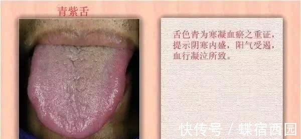 中医内科学|有冠心病的人，舌头有三种“凶相”！