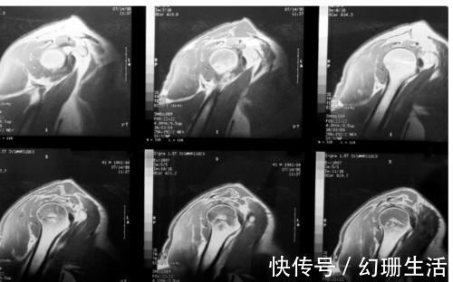 肌腱|肩膀疼痛都是“肩周炎”吗?医生:你错了,肩周炎只占很少一部分