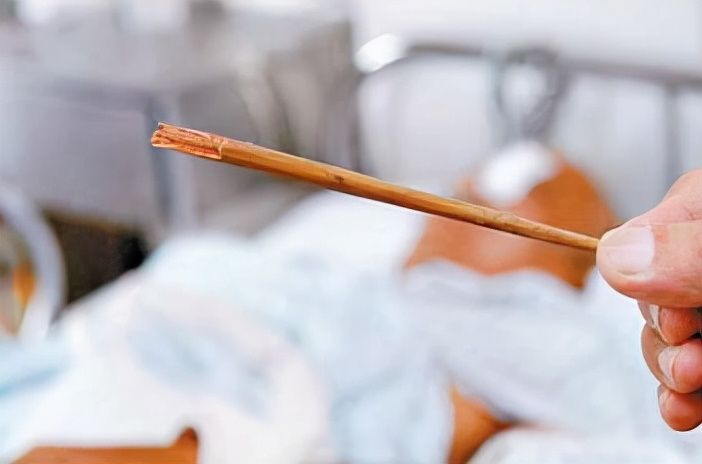 筷子|孩子去医院修牙，竟然在脖子里意外发现一截筷子