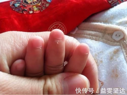 营养均衡|宝宝手上长倒刺,有个常见小动作可能带来危险,正确处理就三步