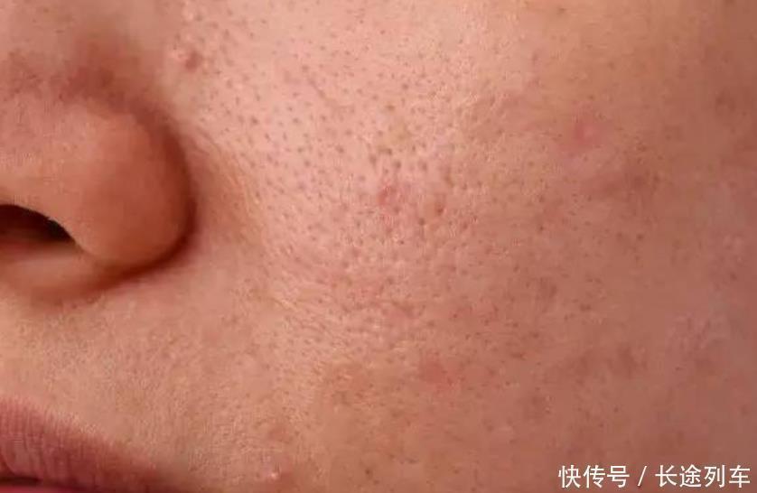 分泌|毛孔粗大特显老,教你几个“小窍门”,在家轻松收缩毛孔成牛奶肌