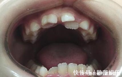 乳牙|7岁男孩乳牙未掉,恒牙又长,医生检查后说道幸亏来得及时