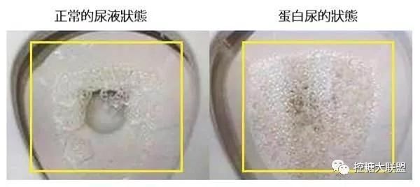 就医|糖尿病人出现这7个信号,说明血糖失控恶化了