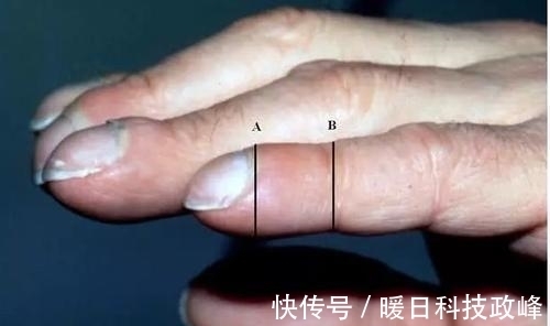 内分泌功能紊乱|46岁阿姨不痛不痒查出肺癌,医生:手上3种标记,已到中晚期