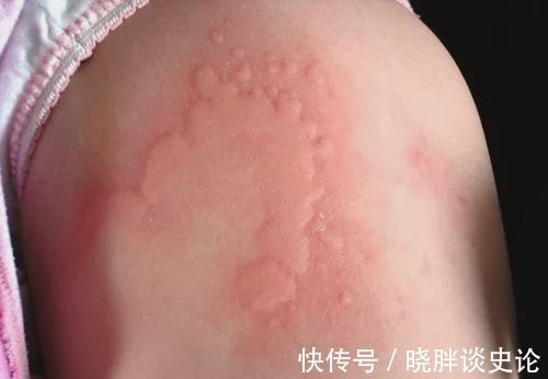 抗组胺药|宝宝得荨麻疹总是想挠怎么办？这个治疗办法百试不爽！