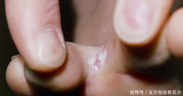 泡脚|用盐水泡脚,可辅助治疗脚气病?医生的答案,却让人意外