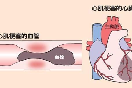 关键时刻|发生了“心梗”如何快速急救?关键时刻能保命,建议大家收藏