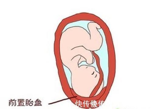 后壁|胎儿前壁好还是后壁好,胎盘前壁优劣势各有两点,孕早期早知道