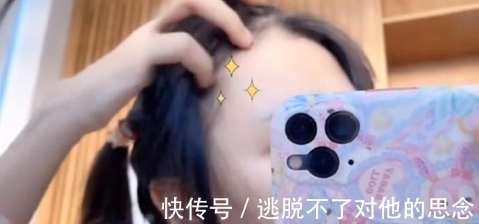 脱发 蔡萝莉真的是一姐?出现秃头危机后,花10多万植发