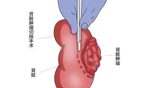 肿瘤|癌症为什么很容易复发？有没有办法预防吗？