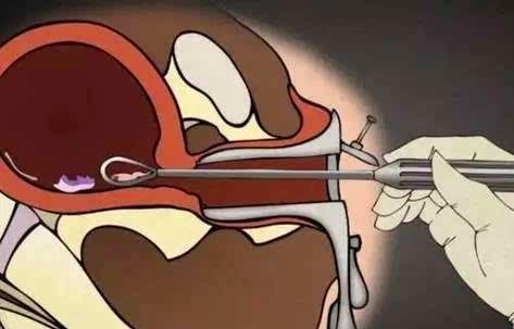 宫颈管|女性做过流产手术真的就容易不孕吗