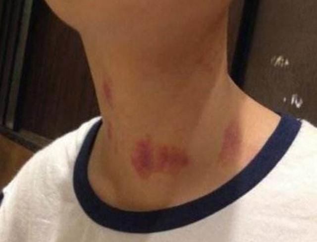 脖子|初二女生脖子长“草莓”,母亲一句话,拯救女儿恋爱观