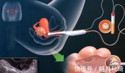 精子|进入女性体内,没和卵子相遇的小蝌蚪去哪了?答案非常有意思