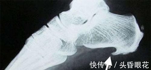 乳腺结节|离癌还远的,身上有没有4个“小突起”,占一个也好,你了占几个