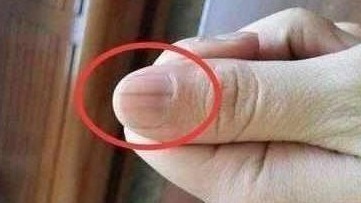 指甲|注意癌症早期,身体会出现3个症状,早看早预防