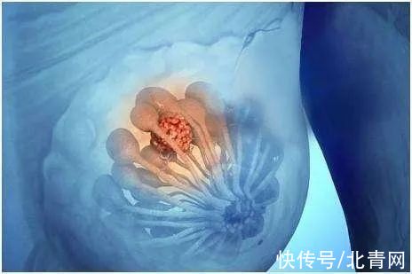 早期|取代肺癌，成为全球第一大癌，这个癌症早期筛查很重要