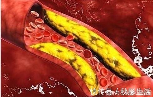 弹性|血管老化容易堵?多吃这“3种”食物,降血脂,恢复血管弹性!