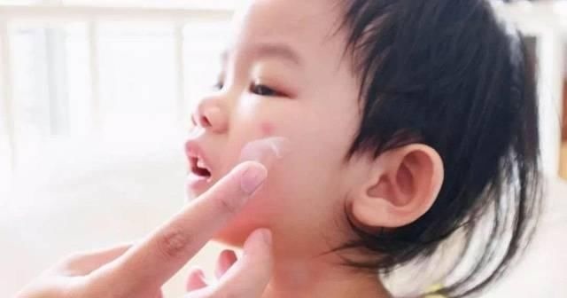 妈妈|宝宝被蚊虫叮咬后,90%妈妈都做错!擦这个止痒最有效!