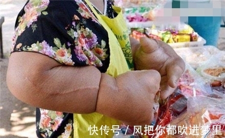 脂肪|女子手臂比大腿还粗,手臂上的脂肪切除掉还是会长出来