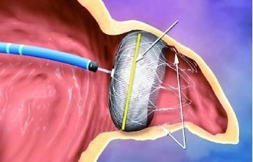 他汀类药物|17.7%的脑梗死患者会复发,怎么办?做到三个坚持是关键