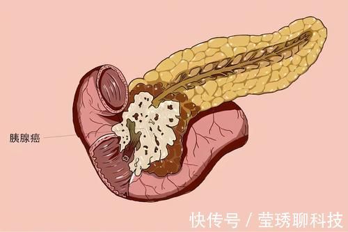 生存率|胰腺癌生存率低,不易被发现,提醒:早期的3个症状,你没当回事