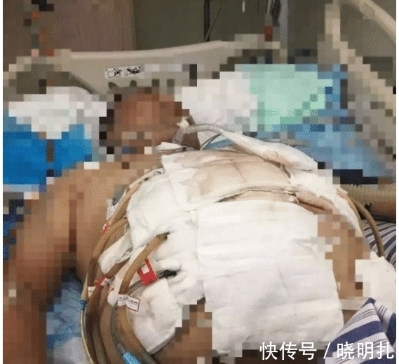 抢救|男子吃一顿火锅在ICU抢救一个月,你还敢胡乱吃东西吗