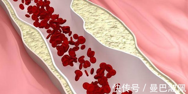 常吃|48岁男子突发脑梗，医生：常吃2种食物，铁打的血管也扛不住