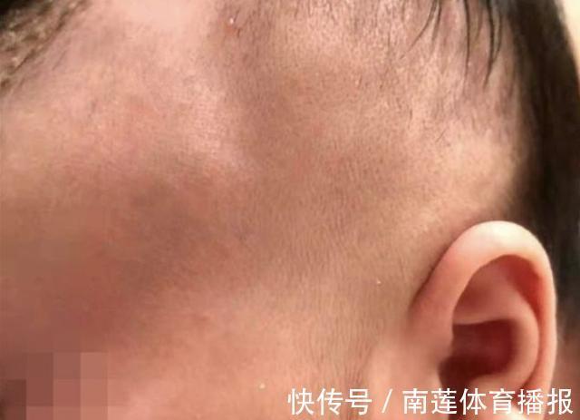 后遗症|因月嫂打瞌睡,出生6天宝宝被摔成颅骨骨折,宝妈:月嫂一天收费500元