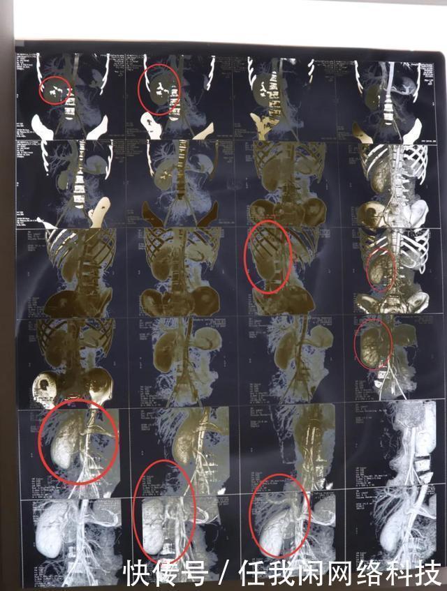 17年前的一场手术后,肾不见了