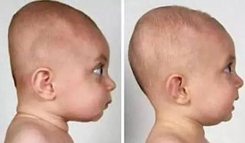 枕头|孩子刚出生就给枕枕头,导致头型太难看,医生询问原因后无奈摇头