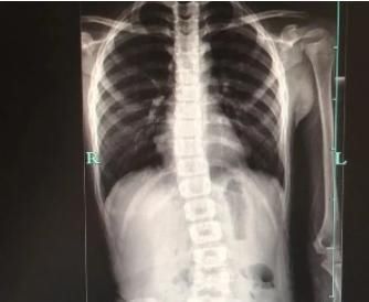 父母|8岁男孩脊椎侧弯,只因家人常做这个动作,这个错误,90%的父母都在犯