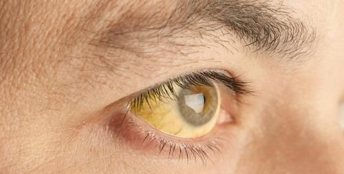 肝癌|肝不好“眼”先知！一旦眼睛有这2种“迹象”，很有可能是肝癌！