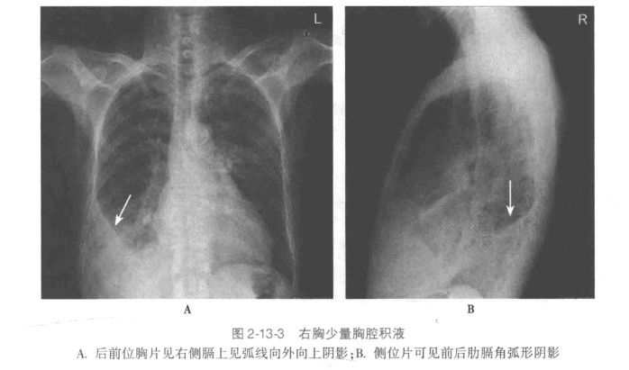 胸腔|肺癌，胸腔积液的诊断与治疗