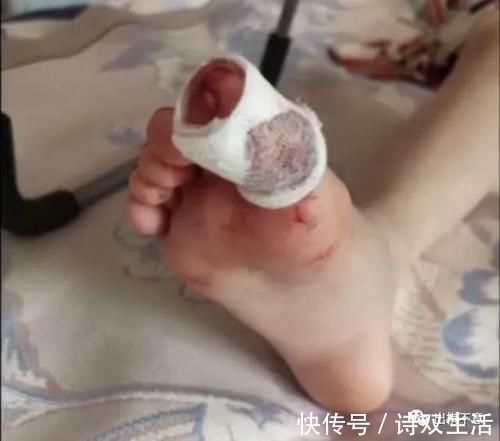 费用|女孩学游泳不慎受伤，治疗费用花了一百多，家长却要索赔三万五