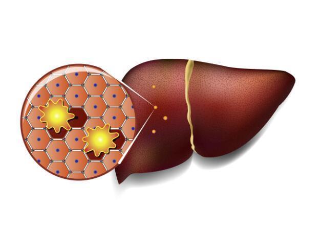 得了脂肪肝,劝你这4种食物不能贪吃,避免加重病情!