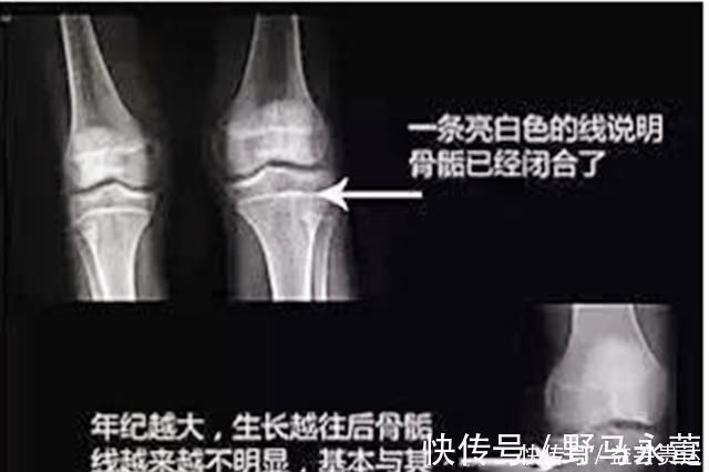 性激素|孩子出现这3个信号,说明骨骼线快要闭合,家长及时补救娃还能长