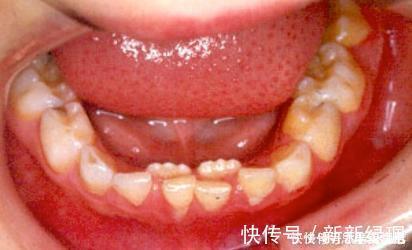 家长们|送给孩子正在换牙的父母们,你们一直都做错了什么?