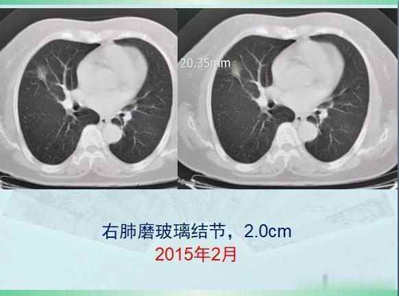 原发灶|两个肺癌病人都拖了2年才治疗,一个治愈,一个扩散了