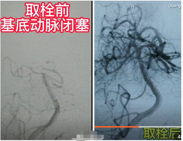 生命|再创生命时速！多科联动助力卒中患者跑赢“死神”