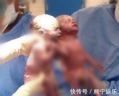 陈女生|做产检发现怀的是连体婴却仍要生,结果小孩出生那一刻所有人都!